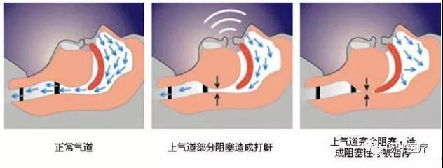 我國3000萬高血壓患者都有這毛病！你知道嗎？